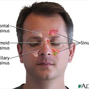 Cure Natural Remedy Sinusitis - Balloon Sinuplasty - A Breakthrough Procedure For Longterm Sinusitis Sufferers