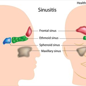 Drinking Water Unblocking Maxillary Sinuses - Herbs And Also Fruit That Cures Sinusitis