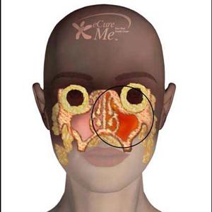 Sinus Headache Diagrams - Balloon Sinuplasty - Just Right With Regard To Sinus
