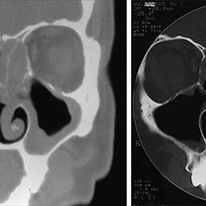 Sinus Trouble - Sinusitis - Causes As Well As Cures