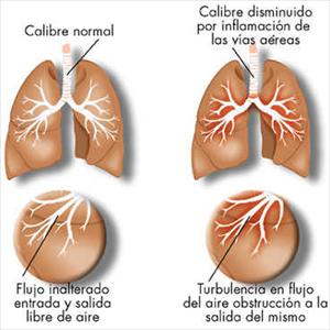 Hoe To Stop Sinus Problems - Nebulized Sinus Treatment For Your Sinusitis