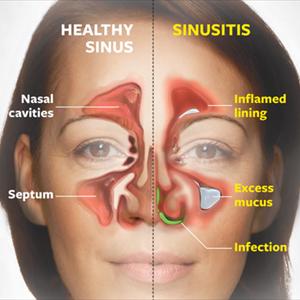 Dizziness And Sinus Problems - Balloon Sinuplasty Remedies Blocked Noses Without Wide Spread Surgery