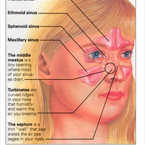 Lung Inflammation From Sinusitis - Sinus Is Curable In Your Home As Well As Hi Technology Health Centre