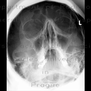 Sinusitis Surgery Costs - Sinusitis Discomfort