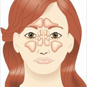 Depression And Headaches Chronic Sinusitis - Natural Sinus Alleviation E-Book Reviews