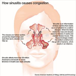 Natural Cures For Fungal Infection In The Nose - Kinds Of Sinusitis