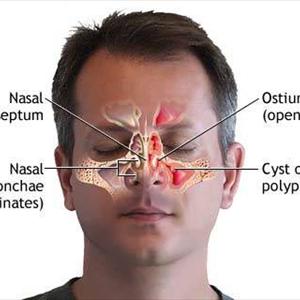 Sinusitis Nose Spray - Methods Used To Avoid A Sinus Infection