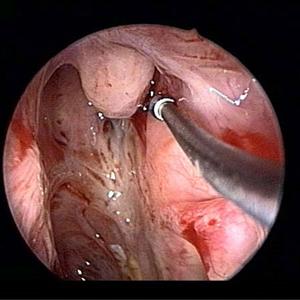 reasons of maxillary sinus