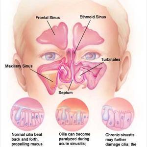 Drinking Water Unblocking Maxillary Sinuses - Herbs And Also Many Fruits That Cures Sinusitis
