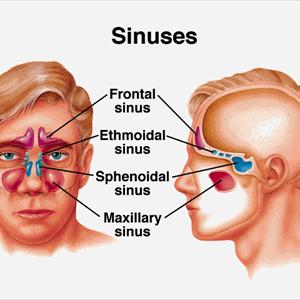 Ethmoid Sinus Headaches - Balloon Sinuplasty - Experience Lasting Relief